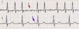 心電図：心房細動（上段）と正常洞調律（下段）