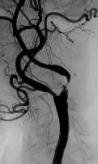 頸動脈（頸の血管）の高度狭窄